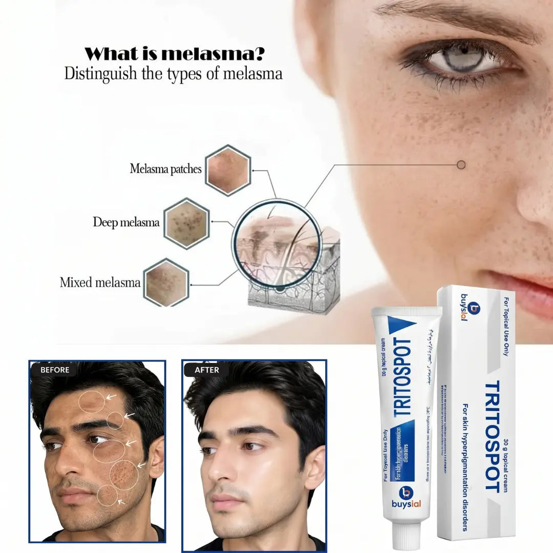 Buysial TRITOSPOT Cream — Treats Melasma Patches Deep Melasma and Mixed Melasma, Male Before and After Dark Spots Treatment 30g