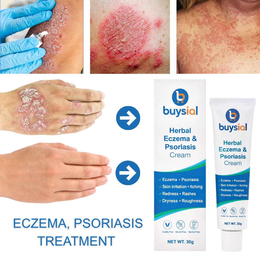 Buysial Herbal Eczema and Psoriasis Cream before and after results 
showing treatment for eczema, psoriasis, skin irritation, redness 
and itching on hands and body