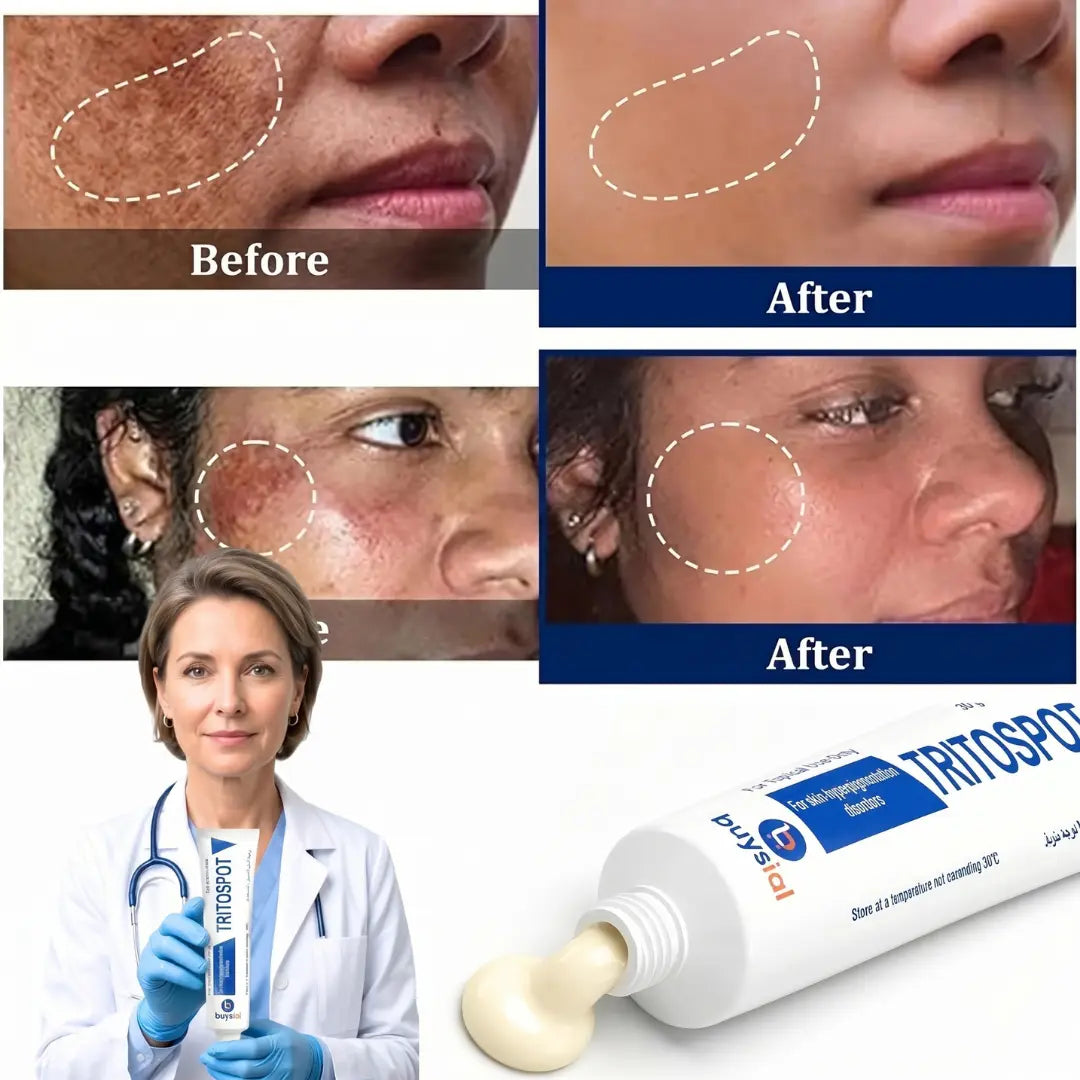 Buysial TRITOSPOT 30g Cream Before and After Results — Visible reduction in dark spots and melasma on face, dermatologist approved