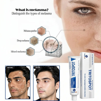 Buysial TRITOSPOT Cream — Treats Melasma Patches Deep Melasma and Mixed Melasma, Male Before and After Dark Spots Treatment 30g